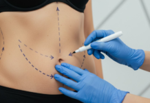 Liposuction Procedure in Jonesboro liposuction clinic