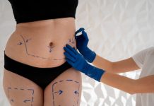 Liposuction Procedure in Jonesboro